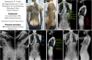 A, B) Imágenes clínicas de espaldas y de perfil del paciente con EIA. C, D) Radiografía postero-anterior y lateral de columna completa en bipedestación del paciente con la medición de los diferentes parámetros radiológicos. E, F) Test de inclinación lateral hacia la derecha e izquierda para valorar la flexibilidad de las curvas y determinar si son o no estructurales. G, H) Planificación preoperatoria de los tipos de tornillos pediculares, su localización, longitud y diámetro, y planificación del tipo, longitud y modelado de las barras. I, J) Resultado radiológico en proyección postero-anterior y lateral de columna completa en bipedestación similar a la planificación preoperatoria. VA: vértebra apical; VE: vértebra estable; VLI: vértebra límite inferior; VLS: vértebra límite superior; VN: vértebra neutra.