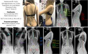 A, B) Imágenes clínicas de espaldas y de perfil del paciente con EIA. C, D) Radiografía postero-anterior y lateral de columna completa en bipedestación del paciente con la medición de los diferentes parámetros radiológicos. E, F) Test de inclinación lateral hacia la derecha e izquierda para valorar la flexibilidad de las curvas, y determinar si son o no estructurales. G, H) Planificación preoperatoria de los tipos de tornillos pediculares, su localización, longitud y diámetro, y planificación del tipo, longitud y modelado de las barras. I, J) Resultado radiológico en proyección postero-anterior y lateral de columna completa en bipedestación que concuerda con la planificación preoperatoria. VA: vértebra apical; VE: vértebra estable: VLI: vértebra límite inferior; VLS: vértebra límite superior; VN: vértebra neutra.