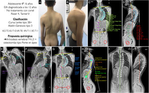 A, B) Imágenes clínicas de espaldas y de perfil del paciente con EIA. C, D) Radiografía postero-anterior y lateral de columna completa en bipedestación del paciente con la medición de los diferentes parámetros radiológicos. E, F) Test de inclinación lateral hacia la derecha e izquierda para valorar la flexibilidad de las curvas y determinar si son o no estructurales. G, H) Planificación preoperatoria de los tipos de tornillos pediculares, su localización, longitud y diámetro, planificación del tipo, longitud y modelado de las barras, y planificación de las osteotomías tipo Ponte y simulación de corrección conseguida con cada una. I, J) Resultado radiológico en proyección postero-anterior y lateral con la consecución de una buena alineación y equilibrio coronal y sagital. VA: vértebra apical; VE: vértebra estable; VLI: vértebra límite inferior; VLS: vértebra límite superior; VN: vértebra neutra.