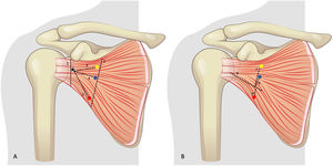 A) Esquema de mediciones. Punto amarillo: nervio subescapular superior. Punto azul: Nervio subescapular medio. Punto rojo: nervio subescapular inferior. 1: distancia craneocaudal a nivel de la interlínea (ScIn). 2: distancia craneocaudal a nivel de los nervios (ScNv). 3: distancia nervio subescapular superior a la interlínea (Sint). 4: distancia nervio subescapular medio a la interlínea (MInt). 5: distancia nervio subescapular inferior a la interlínea (IInt). B) Esquema de mediciones. Punto amarillo: nervio subescapular superior. Punto azul: nervio subescapular medio. Punto rojo: nervio subescapular inferior. 6: división músculo subescapular. 7: distancia nervio subescapular superior a división (SupSplit). 8: distancia nervio subescapular medio a división (MedSplit). 9: distancia nervio subescapular inferior a división (ISplit).
