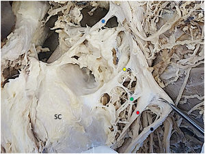 Detalle de ramas del fascículo posterior y tronco superior cara lateral. SC: subescapular. Punto azul: nervio supraescapular. Punto amarillo: nervio subescapular superior. Punto verde: nervio subescapular medio. Punto rojo: nervio axilar. Punto negro: nervio radial.