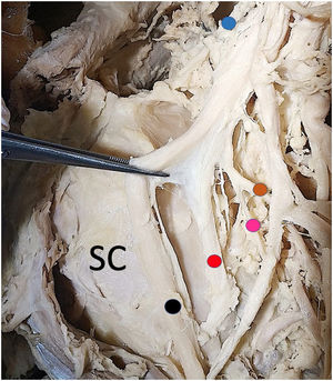 Detalle de ramas del fascículo posterior y tronco superior cara medial. SC: subescapular. Punto azul: nervio supraescapular. Punto marrón: nervio toracodorsal. Punto fucsia: nervio subescapular inferior. Punto rojo: nervio axilar. Punto negro: nervio radial.