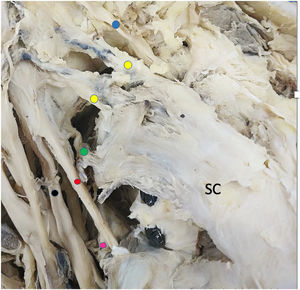 Detalle de ramas del fascículo posterior cara anterior. SC: subescapular. Punto azul: nervio supraescapular. Punto amarillo: nervio subescapular superior. Punto verde: nervio subescapular medio. Punto rojo: nervio axilar. Punto fucsia: nervio subescapular inferior. Punto negro: nervio radial.