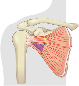 Esquema de la zona segura para la realización de la apertura horizontal del subescapular. Punto amarillo: nervio subescapular superior. Punto azul: nervio subescapular medio. Punto rojo: nervio subescapular inferior. Triángulo morado: zona segura sobre la cara anterior del músculo subescapular.