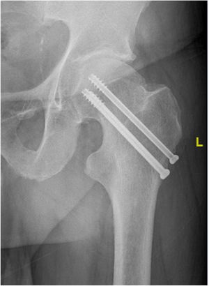 Fractura de cuello femoral fijada con 3 tornillos canulados con configuración en triángulo de base distal (grupo triángulo).