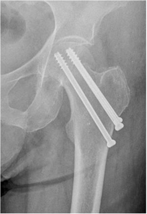 Fractura de cuello femoral fijada con 3 tornillos canulados con configuración en triángulo de base proximal (grupo triángulo invertido).