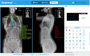 Radiological measurements on anteroposterior and lateral teleradiographs with the Surgimap® programme.