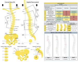 On the left: radiological measurements to be taken on the posteroanterior and lateral radiographs of the total spine in the standing position. Apical vertebra, the one furthest from the CSL and the most rotated. Neutral vertebra, the most proximal under the apex of the greater curve whose pedicles are not rotated, in other words, they are symmetrical. End vertebra, the most proximally and distally inclined at the ends of the major curve. Coronal stable vertebra, the most proximal under the apex of the greater curve which is cut in half by the CSL. A: anterior; FH: femoral head; TRC: triradiate cartilage; R: right; HRL: horizontal reference line; L: left; CSL: central sacral line; LL: lower limbs; P: posterior; PA: posteroanterior; VRL: vertical reference line. On the right: Lenke