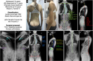 (A and B) Clinical images of the back and profile of the patient with AIS. (C and D) Posteroanterior and lateral radiography of the patient's full spine in standing position with measurement of the different radiological parameters. (E and F) Right and left bending test to assess the flexibility of the curves and determine whether they are structural or not. (G and H) Preoperative planning of the types of pedicle screws, their location, length, and diameter, and planning of the type, length, and shaping of the rods. (I and J) Radiological result in posteroanterior and lateral projection of the complete spine in standing position similar to the preoperative planning. AV: apical vertebra; LEV: lower end vertebra; NV: neutral vertebra; SV: stable vertebra; UEV: upper end vertebra.