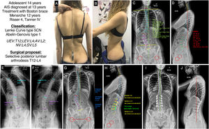 (A and B) Clinical images of the back and profile of the patient with AIS. (C and D) Posteroanterior and lateral radiograph of the patient's entire spine in standing position with measurement of the different radiological parameters. (E and F) Right and left bending test to assess the flexibility of the curves and determine whether they are structural or not. (G and H) Preoperative planning of the types of pedicle screws, their location, length, and diameter, and planning of the type, length, and shaping of the rods. (I and J) Radiological result in posteroanterior and lateral projection of the entire spine in standing position, consistent with the preoperative planning. AV: apical vertebra; LEV: lower end vertebra; NV: neutral vertebra; SV: stable vertebra; UEV: upper end vertebra.