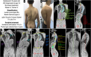 (A and B) Clinical images of the back and profile of the patient with AIS. (C and D) Posteroanterior and lateral radiographs of the patient's entire spine in standing position with measurement of the different radiological parameters. (E and F) Right and left bending test to assess the flexibility of the curves and determine whether they are structural or not. (G and H) Preoperative planning of the types of pedicle screws, their location, length, and diameter, planning of the type, length, and shaping of the rods, and planning of the Ponte-type osteotomies and simulation of the correction achieved with each. (I and J) Radiological result in posteroanterior and lateral projection with the achievement of good coronal and sagittal alignment and balance. AV: apical vertebra; LEV: lower end vertebra; NV: neutral vertebra; SV: stable vertebra; UEV: upper end vertebra.