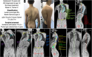 (A and B) Clinical images of the back and profile of the patient with AIS. (C and D) Posteroanterior and lateral radiographs of the patient