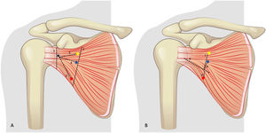 (A) Measurement outline. Yellow dot: superior subscapular nerve. Blue dot: median subscapular nerve. Red dot: inferior subscapular nerve. 1: craniocaudal distance at the level of the interline (ScIn); 2: craniocaudal distance at the level of the nerves (ScNv); 3: superior subscapular nerve distance to the interline (Sint); 4: middle subscapular nerve distance to the interline (MInt); 5: inferior subscapular nerve distance to the interline (IInt). (B) Measurement outline. Yellow dot: superior subscapular nerve. Blue dot: middle subscapular nerve. Red dot: inferior subscapular nerve. 6: subscapularis muscle division; 7: distance superior subscapular nerve to division (SupSplit); 8: middle subscapular nerve to split distance (MedSplit); 9: distance inferior subscapular nerve to division (ISplit).