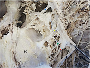Detail of branches of the posterior fascicle and upper trunk on the lateral side. SC: subscapularis. Blue dot: suprascapular nerve. Yellow dot: superior subscapular nerve. Green dot: middle subscapular nerve. Red dot: axillary nerve. Black point: radial nerve.