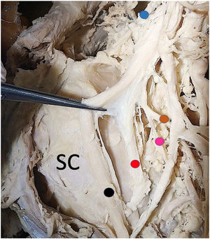 Detail of branches of the posterior fascicle and upper trunk on the medial side. SC: subscapularis. Blue dot: suprascapular nerve. Brown spot: thoracodorsal nerve. Fuchsia point: inferior subscapular nerve. Red dot: axillary nerve. Black point: radial nerve.