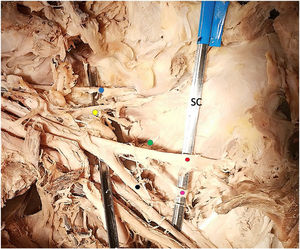 Detail of branches of the posterior fascicle, anterior face. SC: subscapularis. Blue dot: suprascapular nerve. Yellow dot: superior subscapular nerve. Green dot: middle subscapular nerve. Red dot: axillary nerve. Fuchsia point: inferior subscapular nerve. Black point: radial nerve.