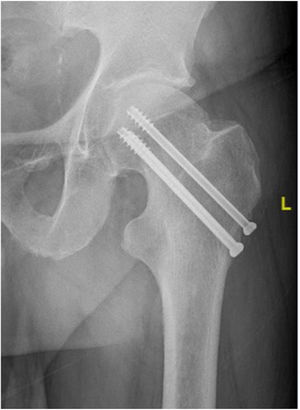 Femoral neck fracture fixed with three cannulated screws with a triangle configuration with a distal base (triangle group).