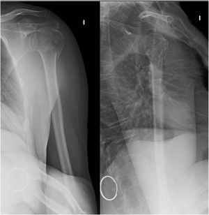 Radiografía de fractura del extremo proximal del húmero bifocal sin impactación metafisaria (AO11B2).