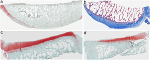 Histología del grupo con resección de la grasa de Hoffa, a) #1 cóndilo femoral con desaparición de cartílago articular; b) #2 cóndilo femoral con estructura normal e hipocelularidad y grupos isogénicos; c) #4 cóndilo tibial con desaparición de cartílago; d) #5 cóndilo tibial cartílago mantiene la estructura tisular y muestra ligera pérdida de proteoglicanos.