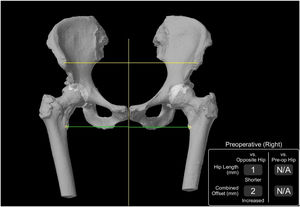 El sistema Mako® (Stryker) permite comparar datos preoperatorios con la cadera contralateral.