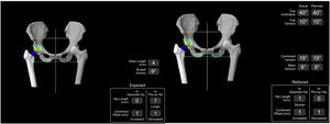 Izquierda: plan preoperatorio propuesto por Mako® (Stryker) y corregido por los cirujanos. Derecha: resultados intraoperatorios tras la implantación de componentes ATC.