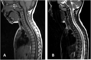 Imagen de RM cervicodorsal de niño de 3 años afectado de lesión medular tipo SCIWORA tras accidente de tráfico. El nivel neurológico de lesión T9 ASIA C, la imagen de la médula espinal ponderada en T1 (A) como en T2 (B) es compatible con la normalidad (SCIWORA clásico). El paciente evolucionó favorablemente a ASIA D al año de la lesión.