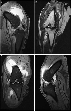 3T sagittal and coronal MRI, studies in (a), (b) T2, without fat suppression, and (c), (d) PD (proton density) with fat suppression (FS).