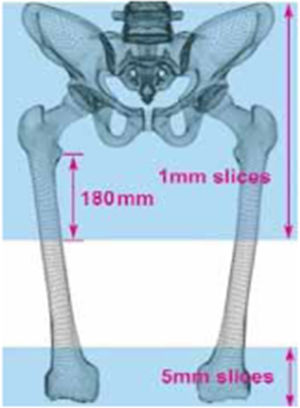 Areas analysed by the Mako® system (Stryker) on the CT for the surgical plan.