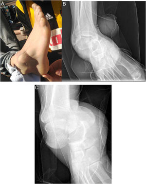 32-Year-old man with pain and deformity in the right foot after forced inversion. The protrusion of the lateral aspect of the talus into the skin can be seen (A). The anteroposterior radiograph shows loss of subtalar congruence, with the calcaneus in a medial position to the talus (B). Lateral radiograph shows loss of congruity at Chopart