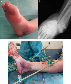43-Year-old man with pain and deformity in his right foot after a traffic accident. A medial skin fold-groove suggestive of incarceration of tendon structures is seen in the context of a lateral subtalar dislocation (A). The anteroposterior radiograph shows a loss of subtalar congruity (B). An open reduction through a medial approach was required due to the incarceration of the posterior tibial tendon around the neck of the talus. After the reduction, an external fixator was implanted to control the stability and evolution of the soft tissues (C).