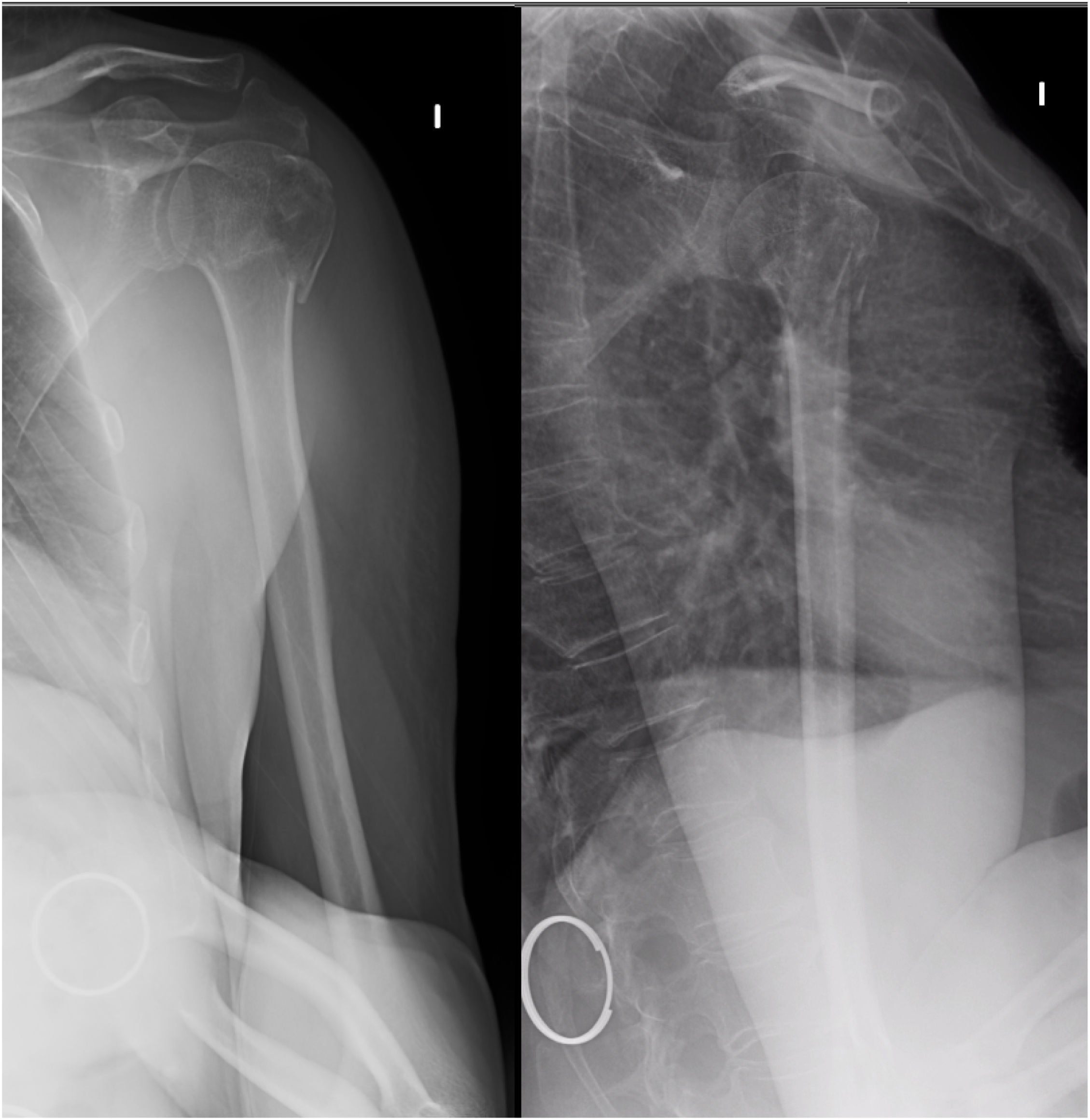 [Translated article] Electromyographic axillary nerve injury in ...