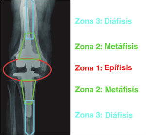 Fijación por zonas en cirugía de revisión de rodilla. Fuente: Morgan Jones et al.2.
