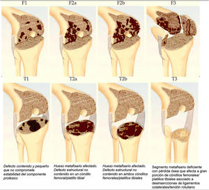 Clasificación Anderson Orthopaedic Research Institute (AORI) de defectos óseos. Fuente: Engh et al.4.