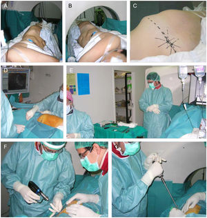 Detalles técnicos para la inserción de tornillos iliosacros en sala de TC.