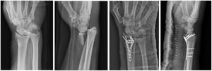 Imágenes anteroposterior y lateral preoperatorias y a las 3 semanas postoperatorias de una fractura de radio distal tipo 2R3B3 AO tratada mediante fijación con placa VA-LCP (Depuy/Synthes, Suiza) e inmovilizada con férula de yeso antebraquial.
