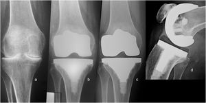 A) Radiografía AP preoperatoria. B) Un año de seguimiento con zona 1 de línea radiolúcida (LRL) de la tibia. C) Catorce años de seguimiento, sin progresión de la LRL. D) Imagen lateral sin LRL a los 14 años de seguimiento.