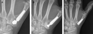 (A) Loosening of the cup of an Elektra® prosthesis. (B) Salvage with cemented cup. (C) New salvage with resection of the trapezium and tenosuspension.