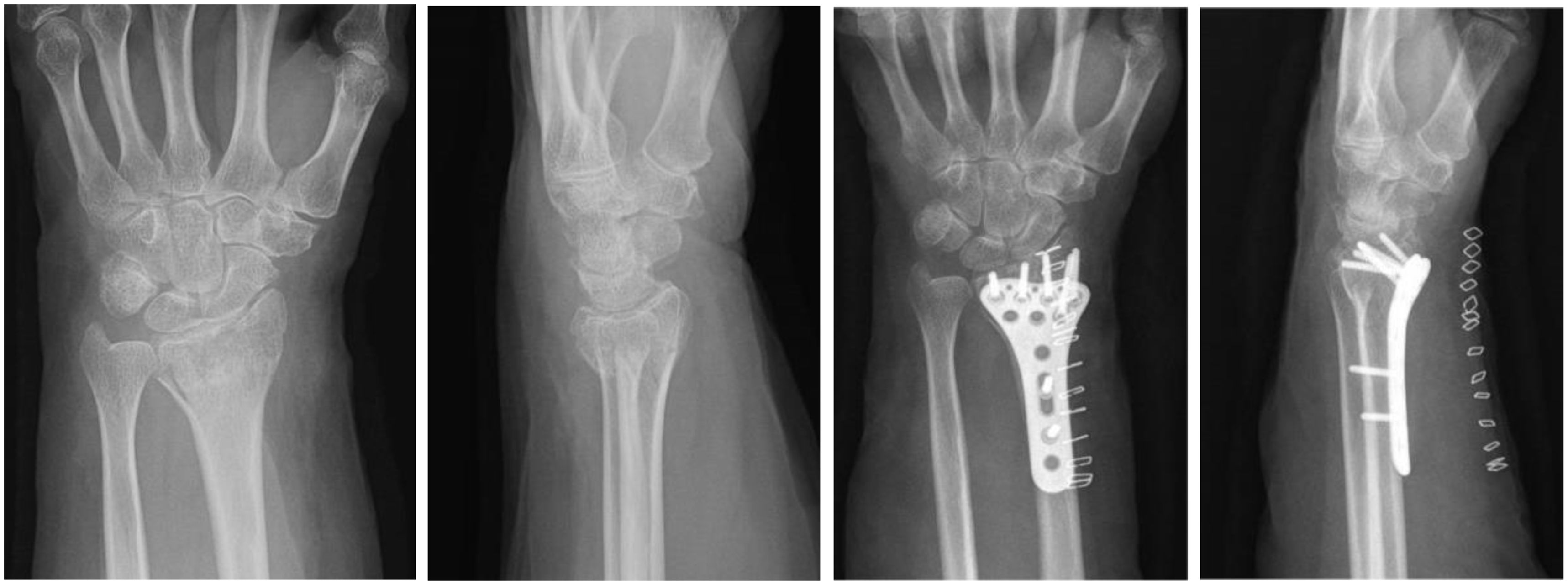 [Translated article] Immobilisation with compression bandage vs ...