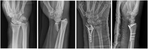Preoperative and 3-week postoperative anteroposterior and lateral images of an AO 2R3B3 distal radius fracture treated with VA-LCP plate fixation (Depuy/Synthes, Switzerland) and immobilised with antebrachial plaster splint.
