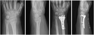 Preoperative and 3-week postoperative anteroposterior and lateral images of an AO 2R3B3 distal radius fracture treated by Variax plate fixation (Stryker, Germany) and immobilised with cotton compression bandage.