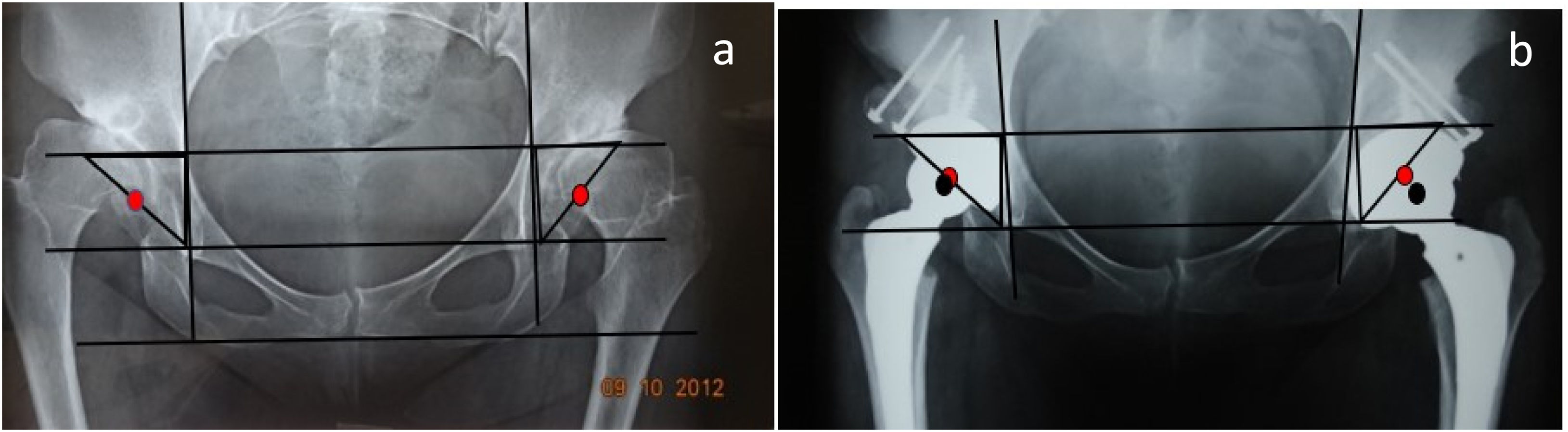 Amar Ranawat Total hip arthroplasty with shelf acetabuloplasty in dysplastic ...