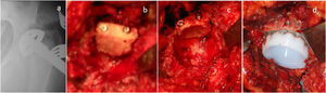 (a) Intraoperative control. (b) Bone autograft fixation. (c) Milling of the graft to implant the cup. (d) Placing the final cup.