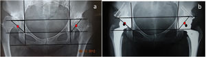 (a) X-ray measuring Ranawat