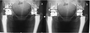 (a) Immediate postoperative radiograph, the percentage of coverage of the host bone for the cup is measured with the following formula: horizontal distance of the cup (X), the coverage of the host bone over the cup (Y) (Y/X)×100. (b) Last follow-up X-ray: we measure the horizontal distance of the cup (X), the bone coverage of the cup (Y′). The percentage of coverage gained is calculated as (Y′−Y)/X×100.25