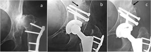 (a) Preoperative radiography. (b) Immediate postoperative radiography. The black arrow points to the native bone and bone graft interface. (c) Postoperative radiography at 9 years. The black arrow indicates the continuity between the native bone and the graft, resorption is observed under the screw heads.