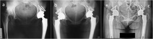 (a) Postoperative X-ray at 6 months of the left hip and initial X-ray of the right hip. (b) Immediate postoperative X-ray of the right hip. (c) Postoperative radiography, 11 years of evolution.