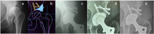(a) Preoperative radiography. (b) Preoperative planning. (c) Immediate postoperative radiography performed acetabuloplasty with femoral head autograft. (d) Postoperative radiography at 3 years; the integration of the autograft on the cup can be identified. (e) Postoperative radiography at 15 years. It is observed that the bone resorption under the heads has been maintained compared to the image, no wear of the polyethylene is seen.