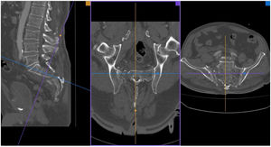 Proyecciones tomográficas de un paciente que sufre un traumatismo de alta energía. Haciendo uso de las diferentes clasificaciones podría catalogarse de Denis II bilateral, Tipo I de Roy Camille, Tipo C3 de la AOSpine y morfológicamente es una fractura en «H».