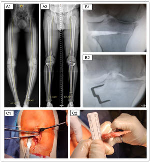 Radiological and intraoperative images of a patient undergoing two-stage bilateral CW-HTO. (A) Telemetry and HKA measurement pre (A.1) and postoperative (A.2). (B) Intraoperative fluoroscopy after removing the subtraction wedge (B.1) and after placing the fixation clip (B.2). (C) Intraoperative clinical images showing the execution of the bone cuts (C.1) and the verification of the thickness of the subtraction wedge once it has been removed (C.2).