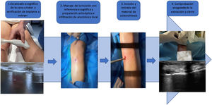 Secuencia de trabajo en la extracción de material de osteosíntesis guiado por ecografía: dinamización de clavo tibial.